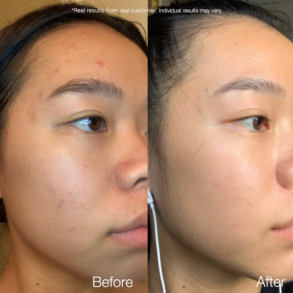 Carrotene Blemish Control SET - APRILSKIN US