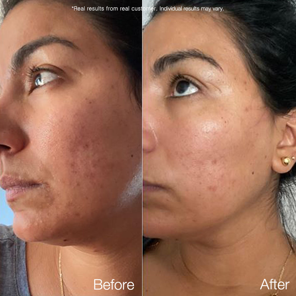Carrotene Trouble-Free Kit (with FREE TOOLS!) - APRILSKIN US